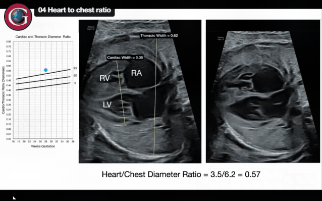 Enhancing cardiac screening in the second and third trimesters